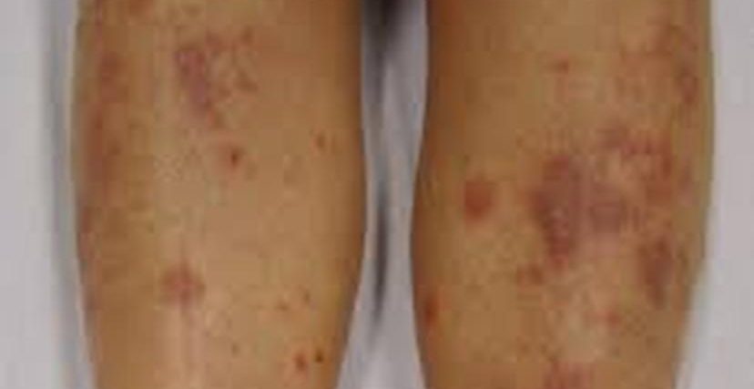 6-ideas-on-how-to-get-rid-of-eczema-scars-on-legs-herbal-suite-blog